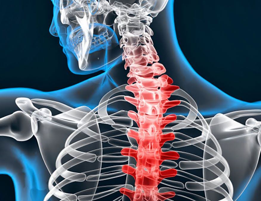 Nekpijn kan uitstralen naar één of beide armen (radiculopathie)