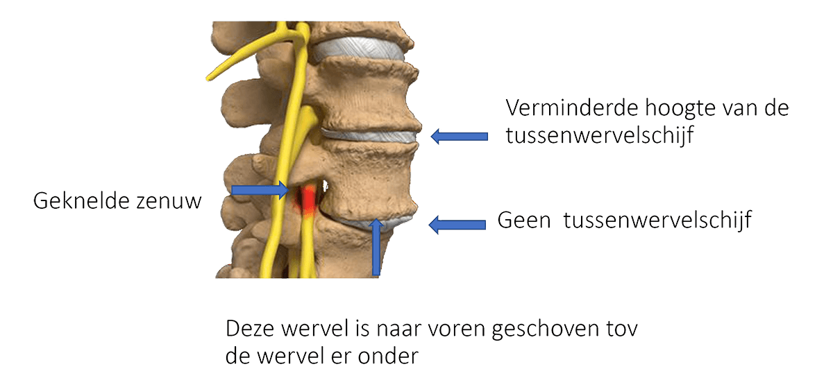 Degeneratieve spondylolisthesis is een aandoening waarbij één wervel naar voren schuift ten opzichte van de daaronder gelegen wervel.