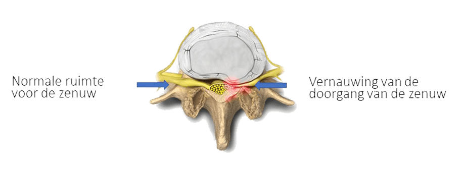 De hernia kan tegen een zenuw aandrukken en dat kan pijn veroorzaken en soms krachtverlies.