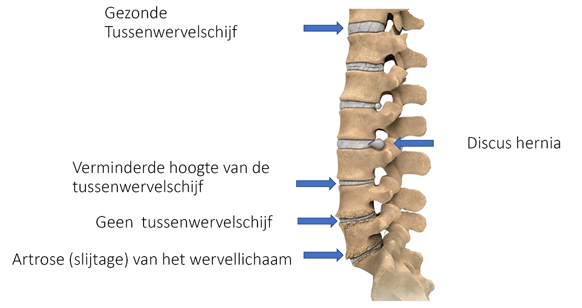 Afbeelding van de ruggewervel met slijtage van de tussenwervelschijf in de onderrug, ook wel degenratieve discopathie genoemd.