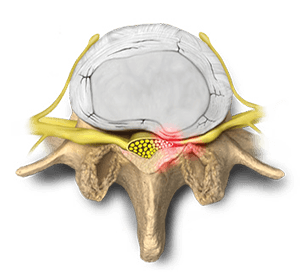 Lumbale spinale stenose is een geleidelijke vernauwing van het centrale kanaal in de rug