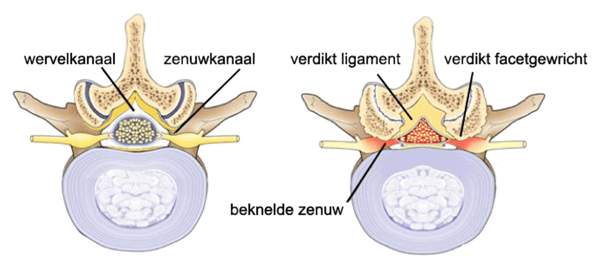 Lumbale spinale stenose is een geleidelijke vernauwing van het centrale kanaal in onze rug