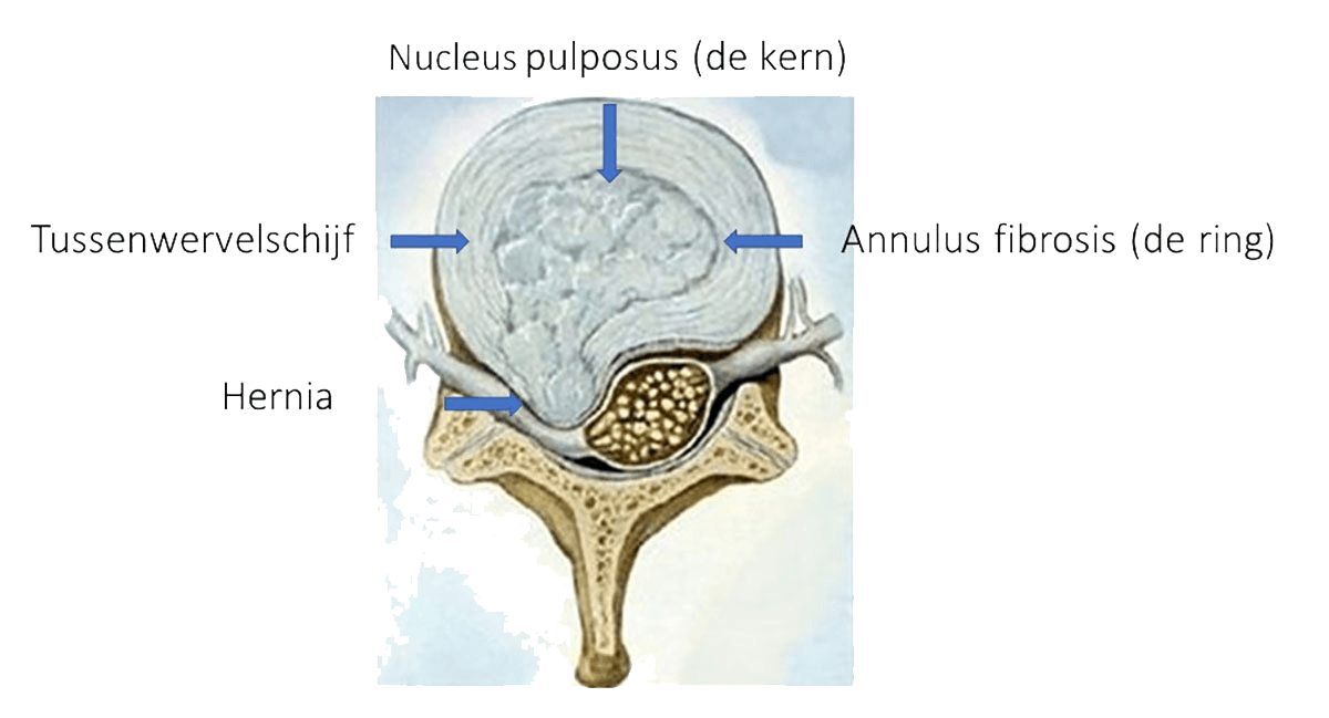 Een tussenwervelschijf bestaat uit een ring van vezelig kraakbeen <em><b>(annulus fibrosis)</b></em> die de kern beschermt.