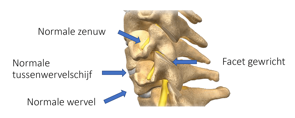 Een ACDF-operatie wordt overwogen bij bijvoorbeeld een discus hernia, een uitstulping van de tussenwervelschijf of een ernstige botvorming (bij artrose)