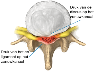 De meeste symptomen worden veroorzaakt door druk op de zenuwwortel en/of het centraal kanaal.