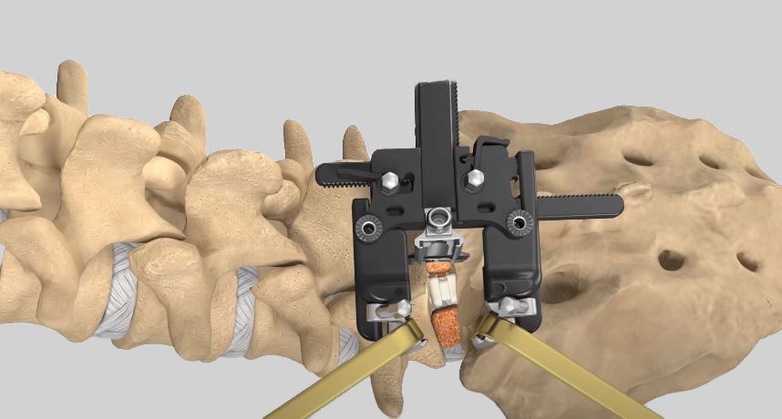 Transforaminale Lumbale Interbody Fusie (TLIF)</strong> is een chirurgische techniek met als doel de rug- en beenpijn weg te nemen door middel van stabilisatie van twee of meerdere wervels.