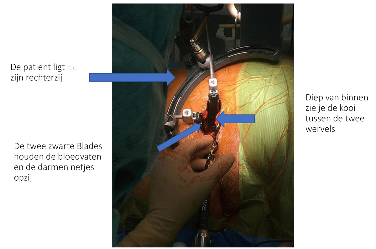 Een ALIF ingreep is een operatie waarbij de beschadigde tussenwervelschijf wordt verwijderd en in de plaats wordt er een titanium kooi geplaatst gevuld met bot.
