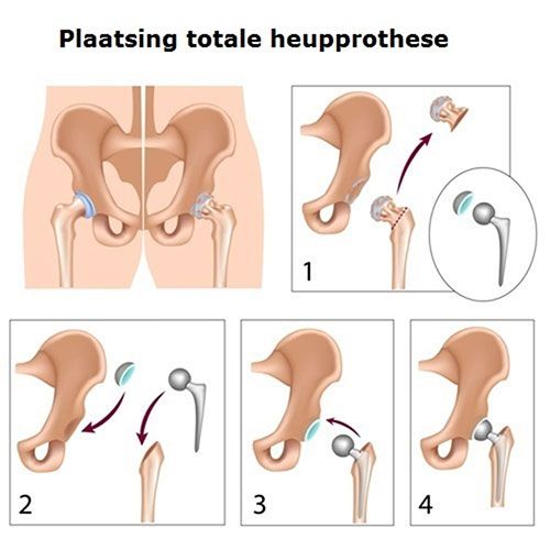 dr. David van Schaik plaatst, sinds enkele jaren, de totale heup prothese (THP) via de spier sparende techniek.