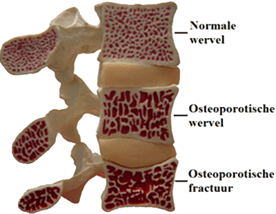 Fracturen en breuken kunnen ontstaan door osteoporose aan de rug